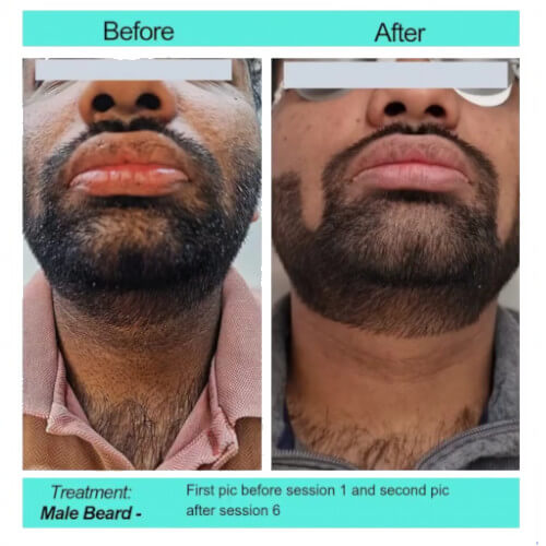Before and After picture of male beard